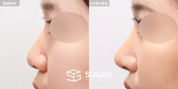 슈가성형외과 첫) 콧대 + 코끝 + 복코 + 비중격 + 귀연골 전후사진 - 측면 수술 전후 비교