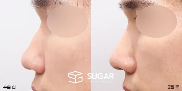 슈가성형외과 재) 코재수술 + 매부리 + 복코 + 기증늑 전후사진 - 측면 수술 전후 비교