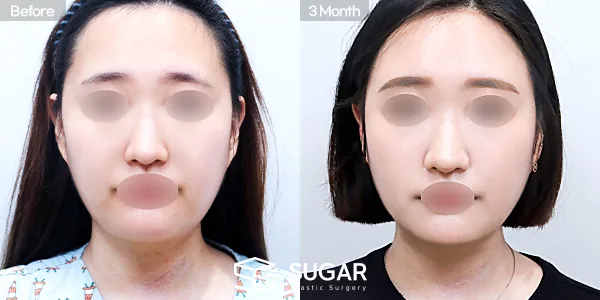 슈가성형외과 첫) 풀페이스 지방이식 전후사진 - 전후 비교 사진