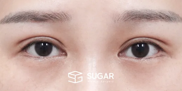 슈가성형외과 재) 재수술(두 줄 따기) + 절개 + 뒤밑트임 전후사진 - 수술 전