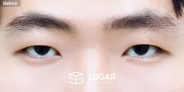 슈가성형외과 첫) 절개 + 눈매교정 + 앞트임 전후사진 - 수술 전