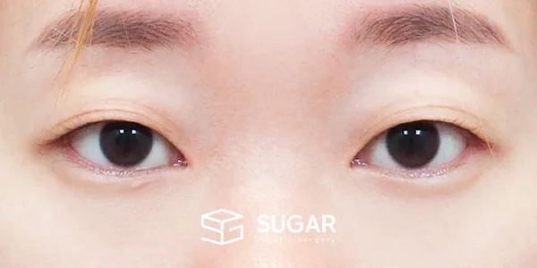 슈가성형외과 첫) 자연유착 전후사진 - 수술 전