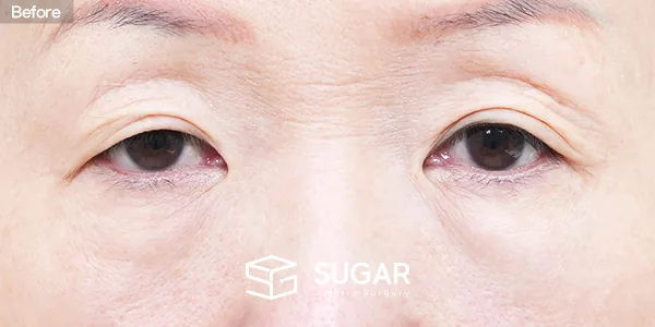 슈가성형외과 첫) 눈매교정 + 눈썹하거상술 + 상안검 + 하안검 + 중안면부거상 전후사진 - 수술 전