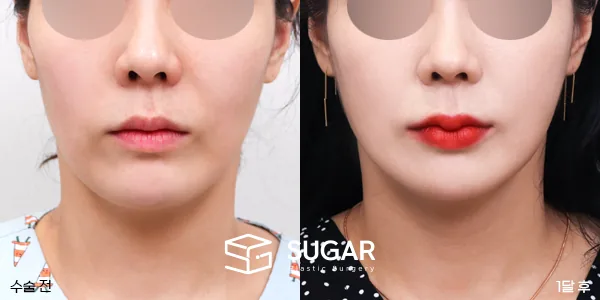 슈가성형외과 첫) 얼굴 지방이식 + 입술필러 전후사진 - 전후 비교 사진