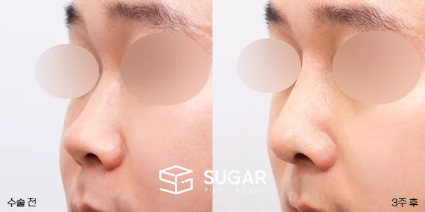 슈가성형외과 첫) 콧대코끝 + 매부리 + 비중격 + 귀연골 전후사진 - 45도 수술 전후 비교