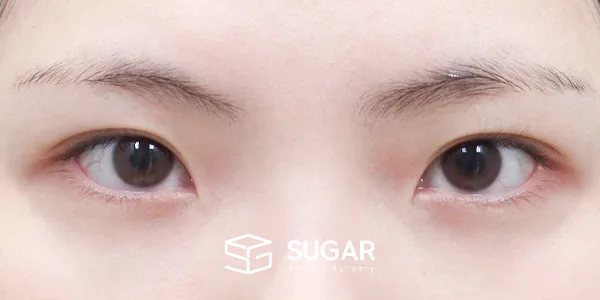 슈가성형외과 첫) 앞트임 + 윗트임 전후사진 - 수술 전