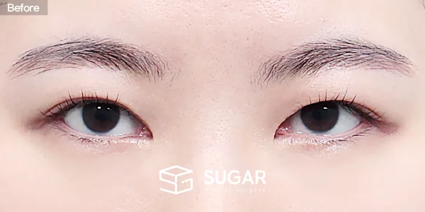 슈가성형외과 재) 재수술 + 절개 전후사진 - 수술 전