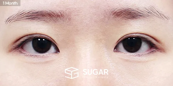 슈가성형외과 첫) 자연유착 + 눈매교정 + 앞트임 + 뒤밑트임 전후사진 - 수술 후