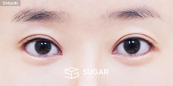 슈가성형외과 재) 재수술 + 절개 + 윗트임 + 뒤밑트임 + 눈밑지방재배치 전후사진 - 수술 후