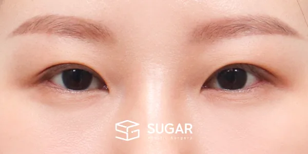슈가성형외과 첫) 절개 + 눈매교정 전후사진 - 수술 후
