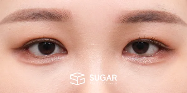 슈가성형외과 재) 재수술 + 뒤밑트임 전후사진 - 수술 후