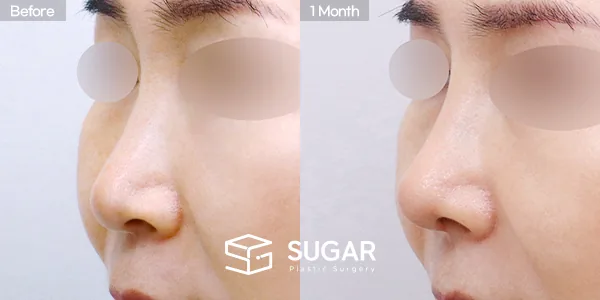 슈가성형외과 첫) 콧대 + 코끝 + 귀연골 + 비중격연골 + 복코 전후사진 - 45도 수술 전후 비교
