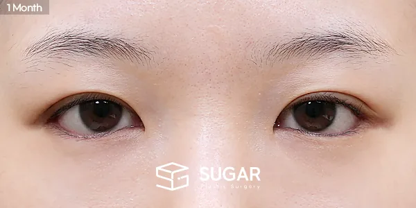 슈가성형외과 첫) 뒤밑트임 전후사진 - 수술 후