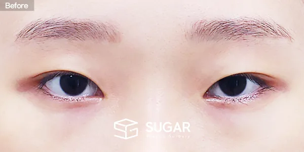 슈가성형외과 첫) 자연유착 + 눈매교정 + 윗트임 + 앞트임 + 뒤밑트임 + 눈밑지방재배치 전후사진 - 수술 전