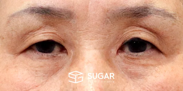 슈가성형외과 첫) 눈썹 거상 + 상안검 + 눈 위 지방 제거 전후사진 - 수술 전