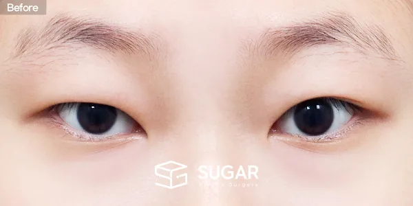 슈가성형외과 첫) 자연유착 + 눈매교정 + 윗트임 전후사진 - 수술 전