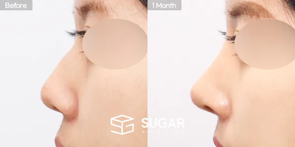 슈가성형외과 첫) 콧대 + 코끝 + 매부리코 + 절골 + 비중격 + 귀연골 전후사진 - 측면 수술 전후 비교