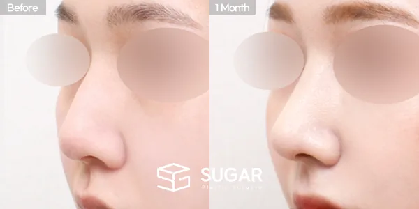 슈가성형외과 첫) 코끝 + 매부리코 + 절골 전후사진 - 45도 수술 전후 비교