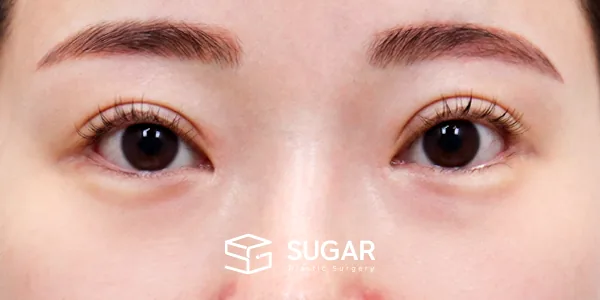 슈가성형외과 재) 재수술 + 뒤밑트임 + 눈 밑 지방재배치 전후사진 - 수술 전