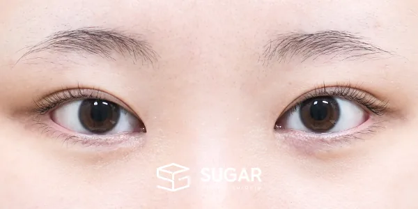 슈가성형외과 첫) 자연유착 + 눈매교정 + 앞트임 전후사진 - 수술 후