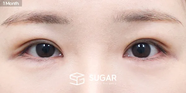 슈가성형외과 첫) 자연유착 + 눈매교정 + 앞트임 전후사진 - 수술 후