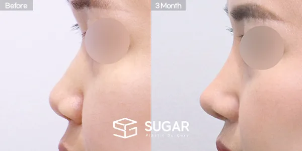 슈가성형외과 첫) 콧대 + 코끝 + 비중격연골 + 귀연골 + 복코 전후사진 - 측면 수술 전후 비교