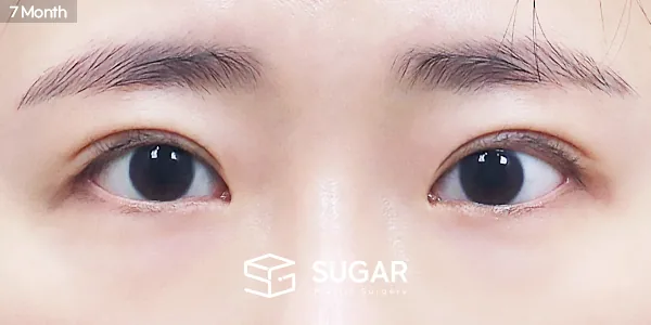 슈가성형외과 재) 재수술 + 자연유착 + 눈매교정 + 윗트임 전후사진 - 수술 후