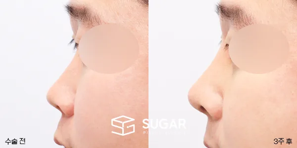 슈가성형외과 첫) 콧대코끝 + 매부리 + 비중격 + 귀연골 전후사진 - 측면 수술 전후 비교