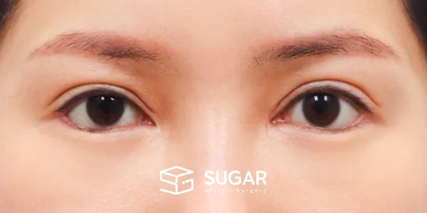 슈가성형외과 첫) 뒤밑트임 전후사진 - 수술 후