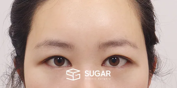 슈가성형외과 재) 이마거상+자연유착재수술+뒤트임+밑트임 전후사진 - 수술 후