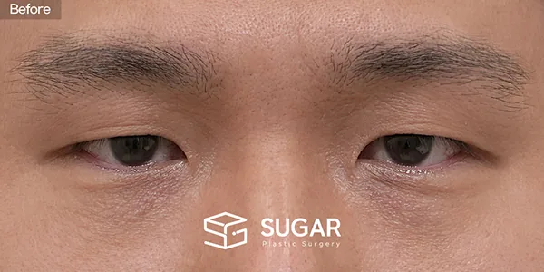 슈가성형외과 첫) 눈썹거상술 + 매몰쌍꺼풀 + 눈매교정 전후사진 - 수술 전