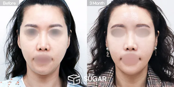 슈가성형외과 첫) 중안면부거상 + 풀페이스 지방이식 + 이중턱 지방흡입 + 실리프팅 전후사진 - 전후 비교 사진