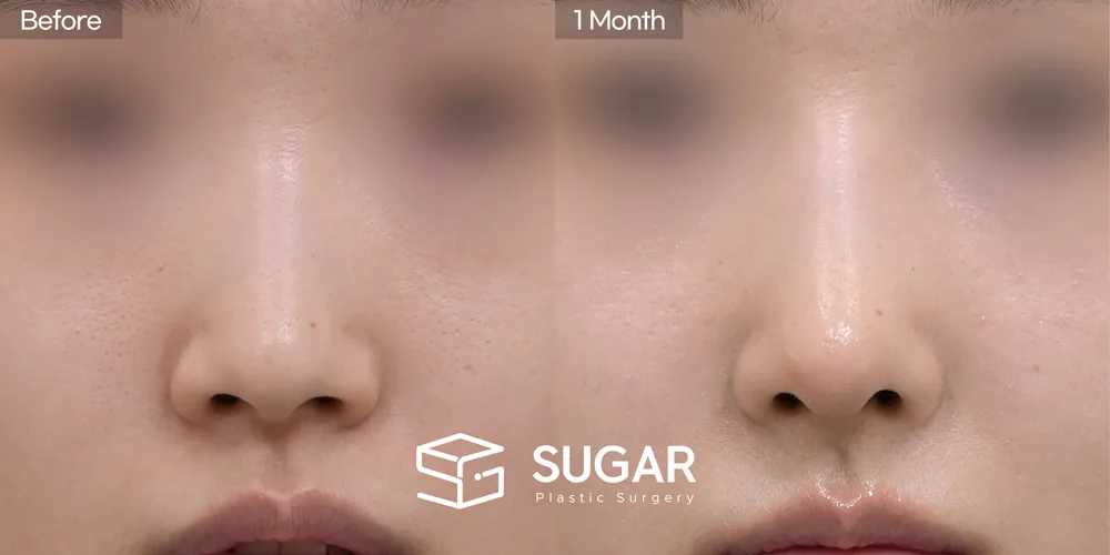 슈가성형외과 첫) 기증늑 + 귀연골 + 콧대 + 절골 + 복코 전후사진 - 정면 수술 전후 비교