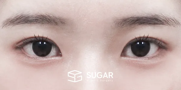 슈가성형외과 첫) 자연유착 + 눈매교정 전후사진 - 수술 후
