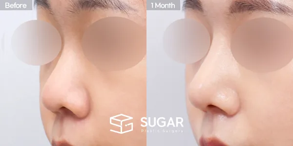 슈가성형외과 첫) 콧대 + 코끝 + 복코 전후사진 - 45도 수술 전후 비교