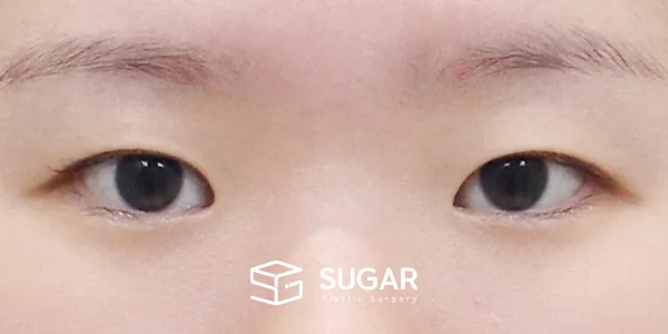 슈가성형외과 첫) 자연유착 + 앞트임 + 윗트임 + 뒤밑트임 전후사진 - 수술 전