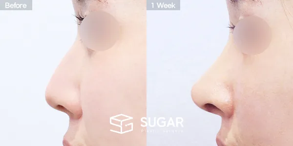 슈가성형외과 첫) 콧대 + 코끝 + 무보형물 + 비중격연골 + 귀연골 + 매부리 + 복코+ 휜코 + 귀 뒤 근막 전후사진 - 측면 수술 전후 비교