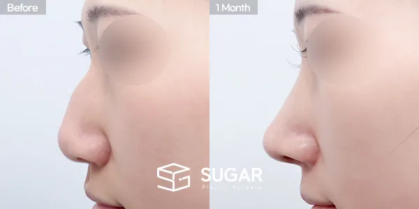 슈가성형외과 첫) 무보형물+비중격연장+매부리코+절골+복코 전후사진 - 측면 수술 전후 비교