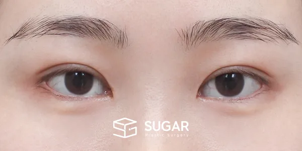 슈가성형외과 첫) 자연유착 + 눈 위 지방제거 전후사진 - 수술 후
