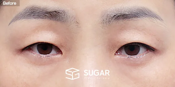 슈가성형외과 첫) 눈썹하거상술 + 자연유착 + 눈매교정 + 윗트임 전후사진 - 수술 전