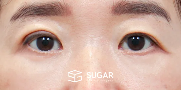 슈가성형외과 첫) 중안면부 거상 + 하안검 전후사진 - 수술 후