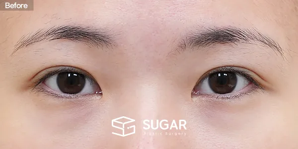 슈가성형외과 재) 뒤트임 재수술 + 밑트임 + 눈밑지방재배치 전후사진 - 수술 전