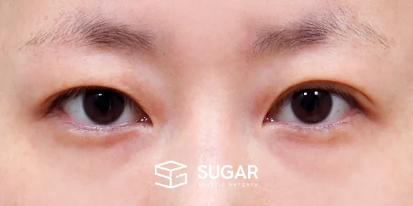 슈가성형외과 재) 재수술 + 자연유착 전후사진 - 수술 전