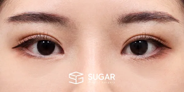 슈가성형외과 첫) 자연유착 + 눈매교정 + 앞트임 전후사진 - 수술 후