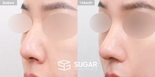 슈가성형외과 첫) 복코 + 매부리코 + 절골 전후사진 - 45도 수술 전후 비교