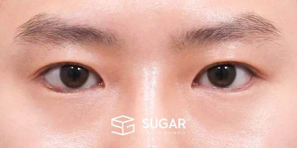 슈가성형외과 첫) 절개 + 앞트임 + 뒤밑트임 전후사진 - 수술 후