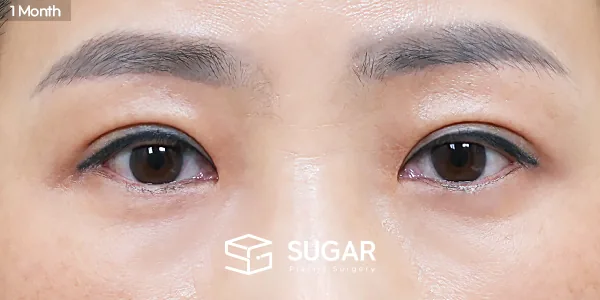 슈가성형외과 첫) 눈썹하거상술 + 자연유착 + 눈매교정 + 윗트임 전후사진 - 수술 후