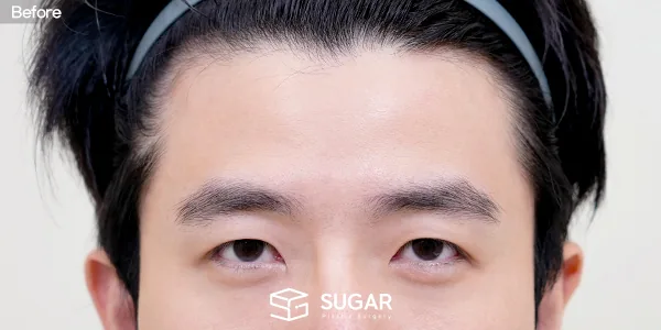 슈가성형외과 첫) 이마거상 + 뒤트임 전후사진 - 수술 전