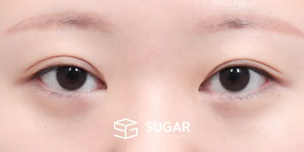 슈가성형외과 재) 절개 + 재수술 전후사진 - 수술 전