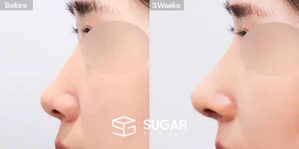 슈가성형외과 첫) 콧대 + 코끝 + 매부리코 + 절골 + 비중격 + 귀연골 전후사진 - 측면 수술 전후 비교